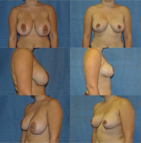 breast reduction surgery tunbridge wells