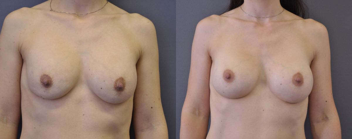 breast revision before and after turnbridge wells kent london