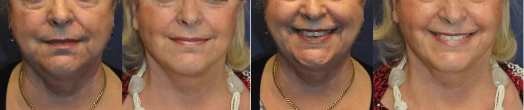 Best Facelift Surgeon Kent