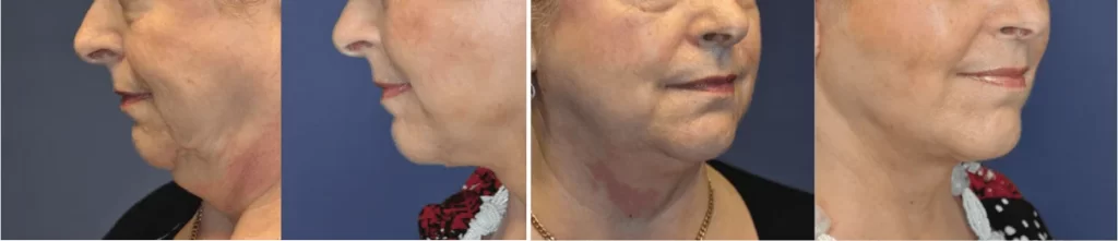  facelift and neck lift surgery tunbridge wells kent