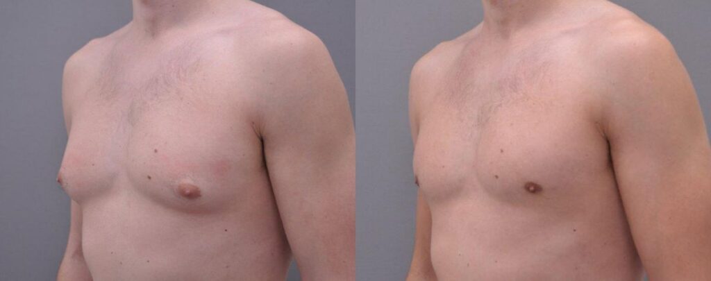 best gynaecomastia (gynecomastia) surgeon tunbridge wells kent and london