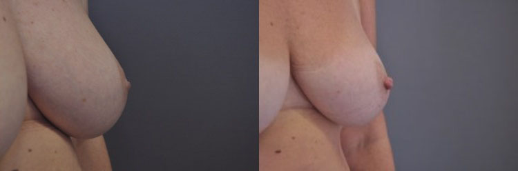 inverted nipple correction surgery before and after turnbridge wells kent london