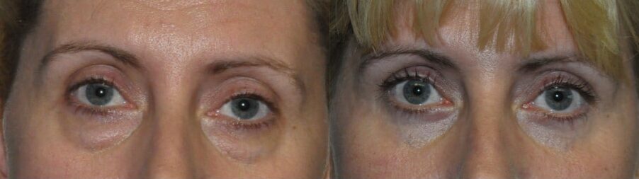 lower eyelid blepharoplasty kent