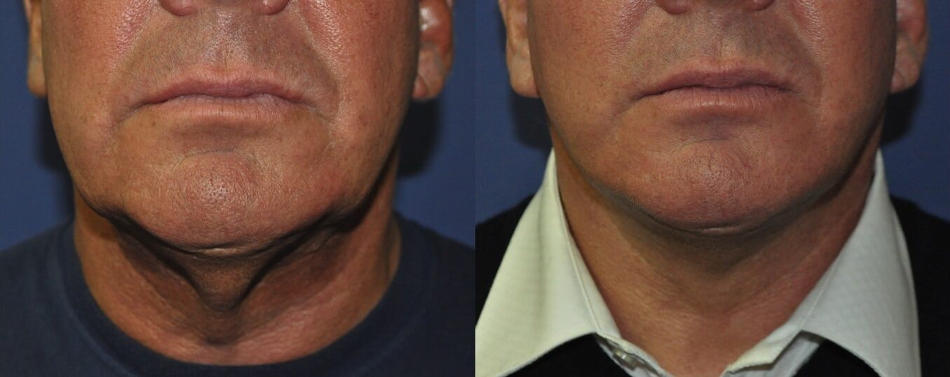 Best facelift surgeon kent male facelift before and after