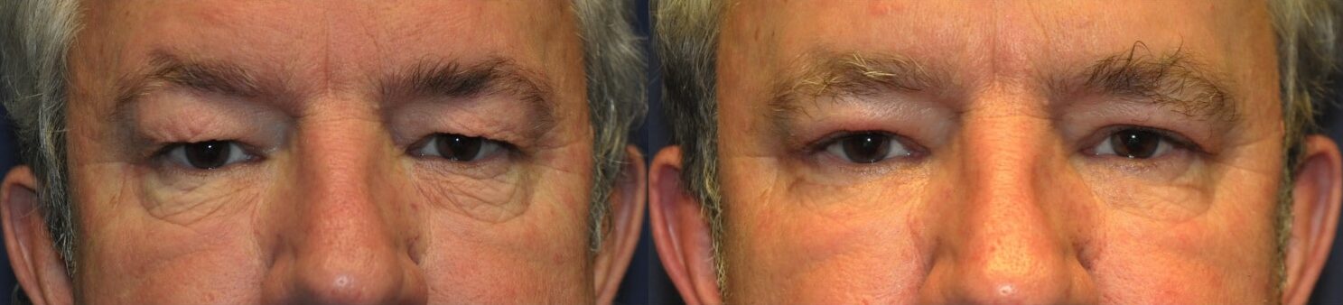 male patient upper and lower blepharoplasty front view tunbridge wells kent