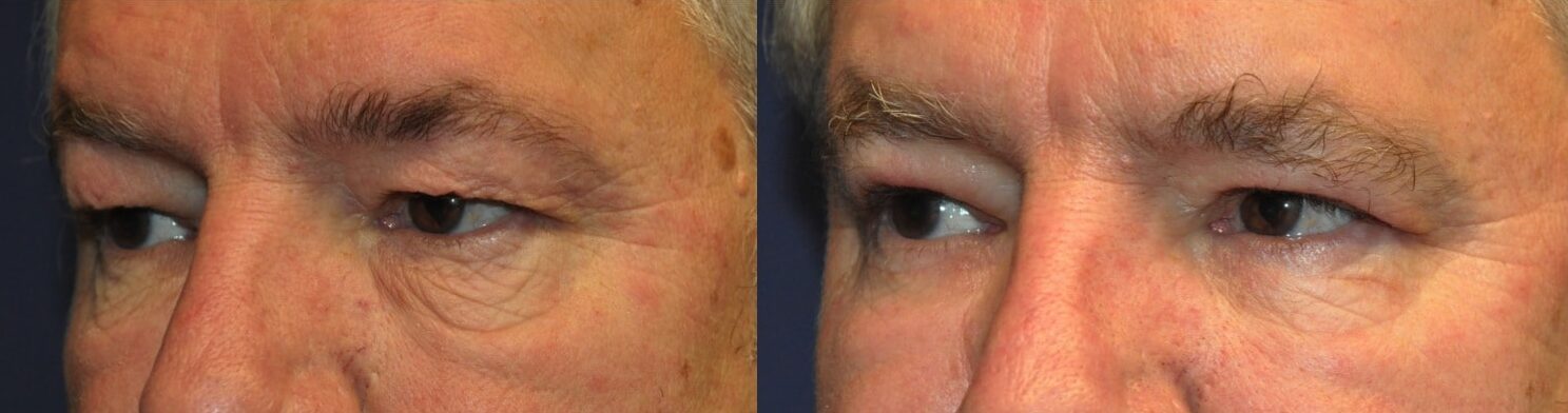 male patient upper and lower blepharoplasty oblique view tunbridge wells kent