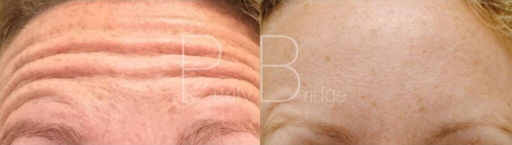 anti wrinkle injections botox tunbridge wells kent