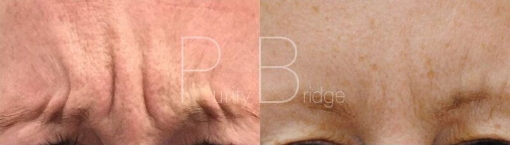 botox anti wrinkle injections tunbridge wells kent