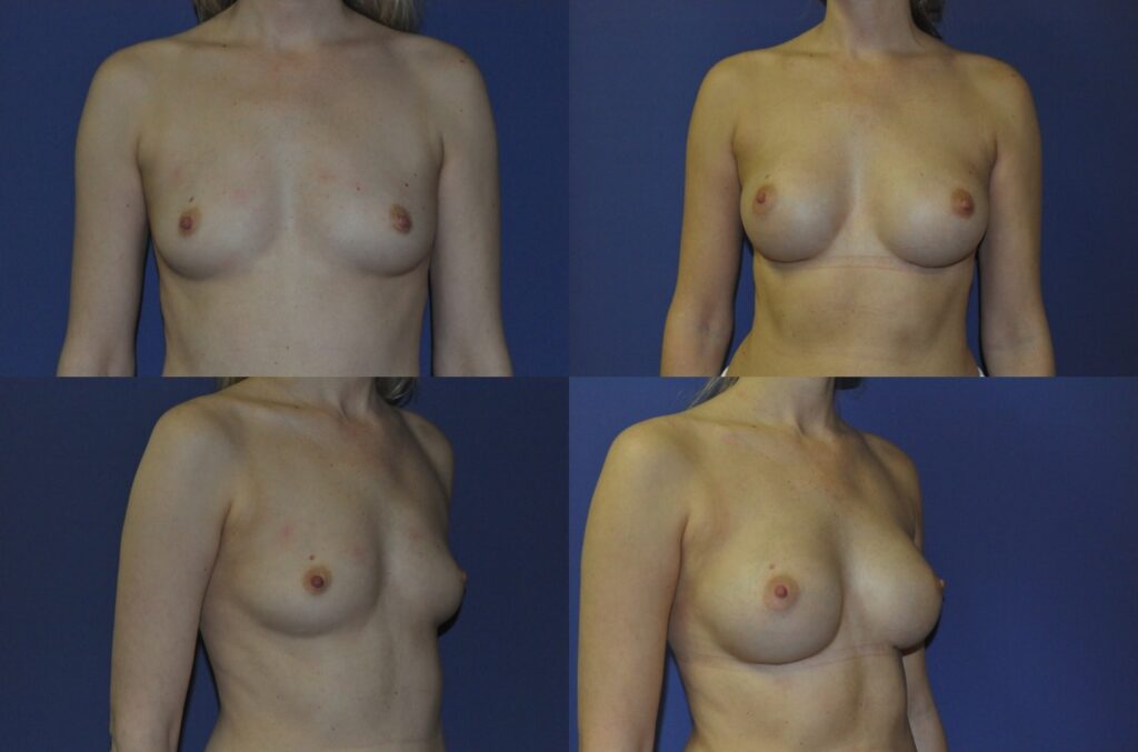 A patient of Mr Pacifico who has had a subglandular breast augmentation using low profile anatomical silicone breast implants