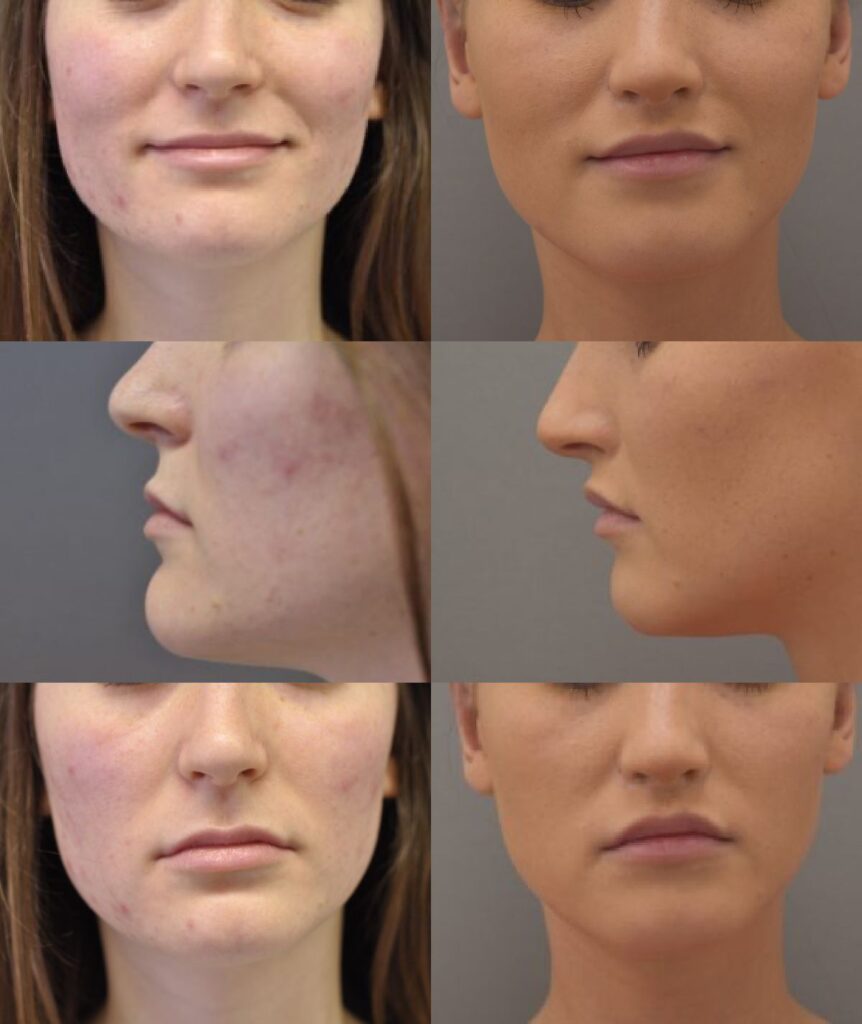 Before and After Lip Lift Surgery. Marc Pacifico Tunbridge Wells Kent