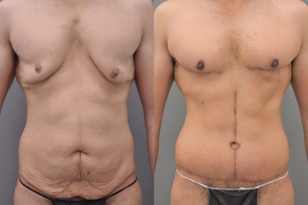 best post weight loss plastic surgeon tunbridge wells kent london