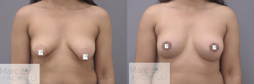 Tuberous breast correction Tunbridge Wells Kent London