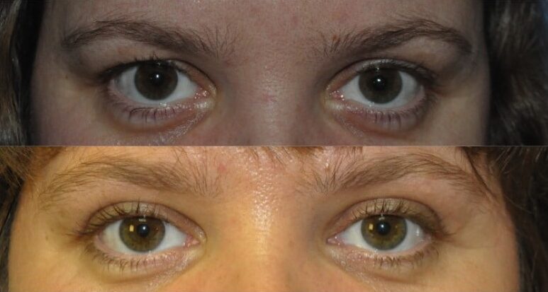 upper blepharoplasty eyelid surgery in tunbridge wells kent london