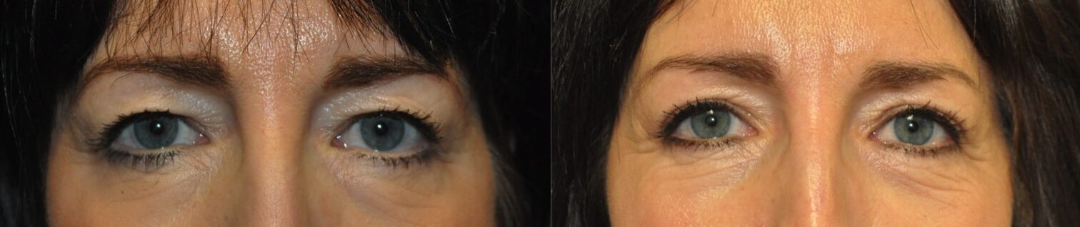 upper blepharoplasty with brow lift frontal view tunbridge wells kent