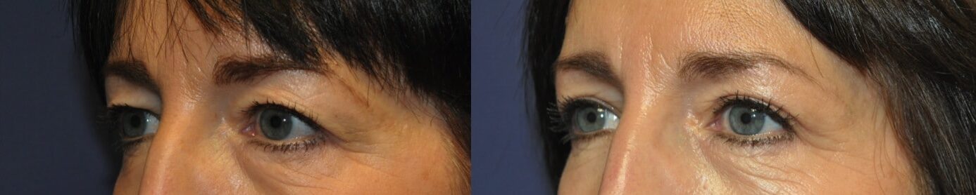 upper blepharoplasty with brow lift oblique view tunbridge wells kent