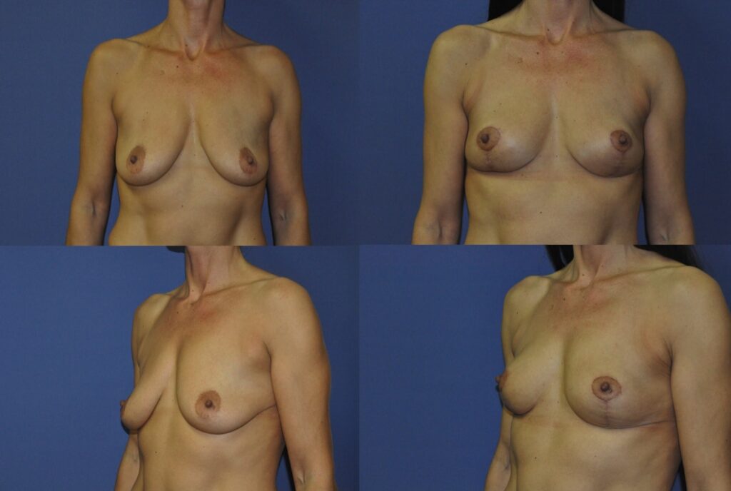 best mastopexy surgeon tunbridge wells