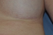 Well healed and mature scar 1 year after a breast augmentation