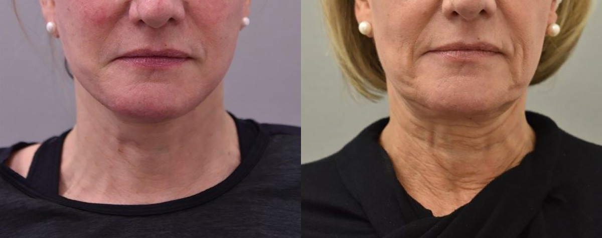 Deep Neck lift results